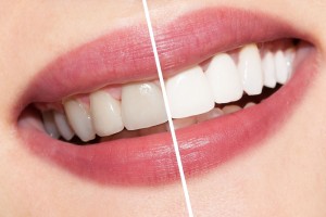 Teeth Whitening | Family Dental Care